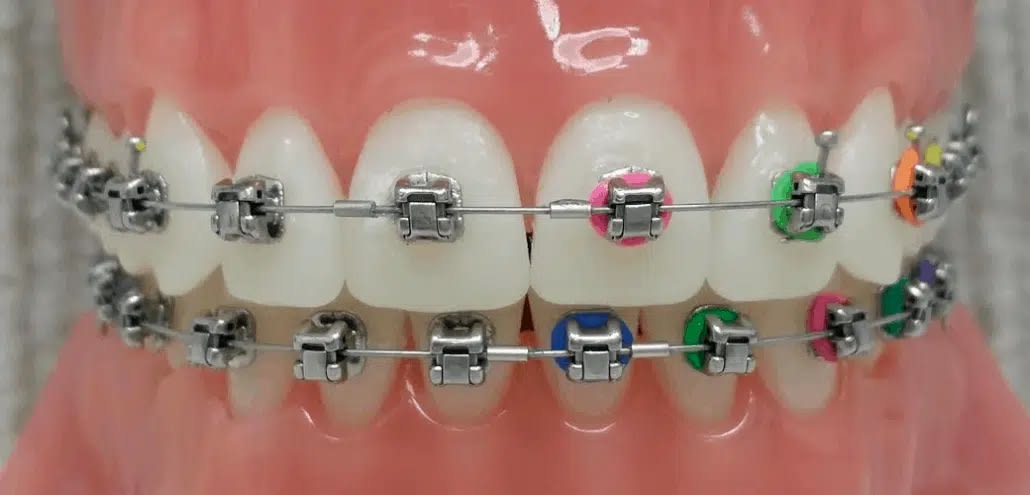 Damon Braces