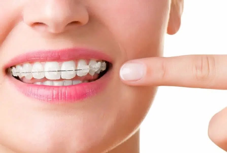 Damon Braces