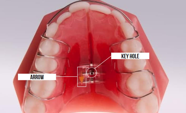 Image showing an orthodontic expander in place