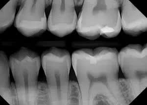 An X-ray of teeth