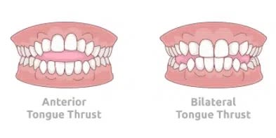 Mouth breathing