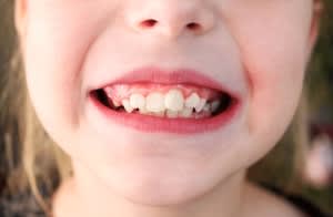 A child is showing off their teeth.