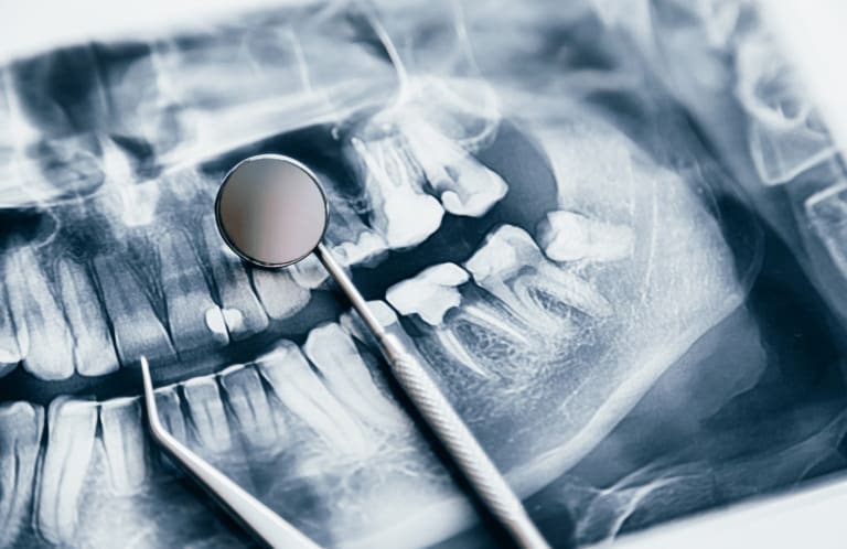 X-ray image with dental tools laying on top