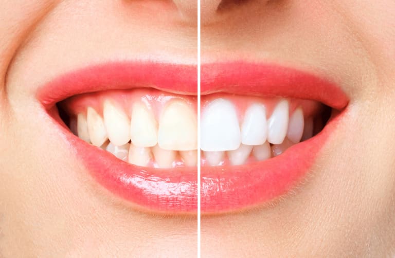 Before and after image showing before and after teeth whitening