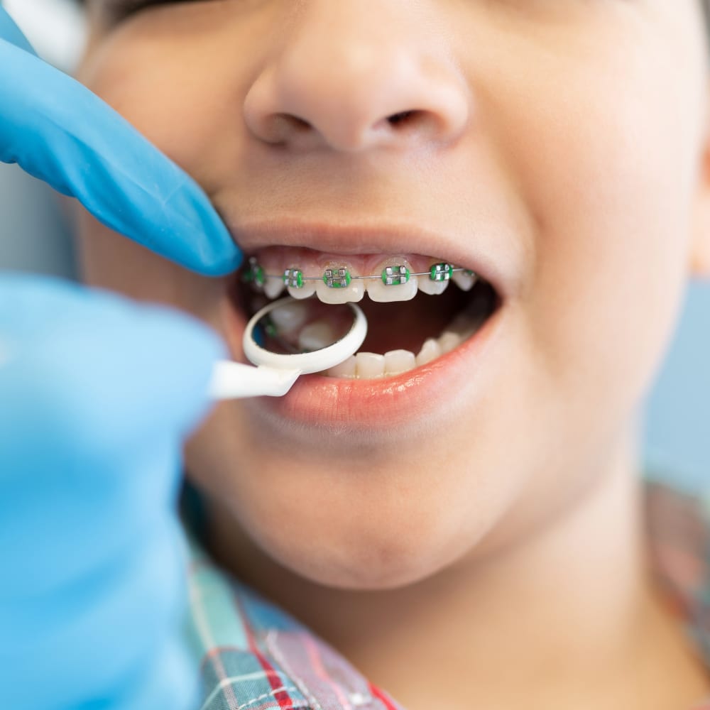 Close-up of an orthodontist checking a young boy's green braces.