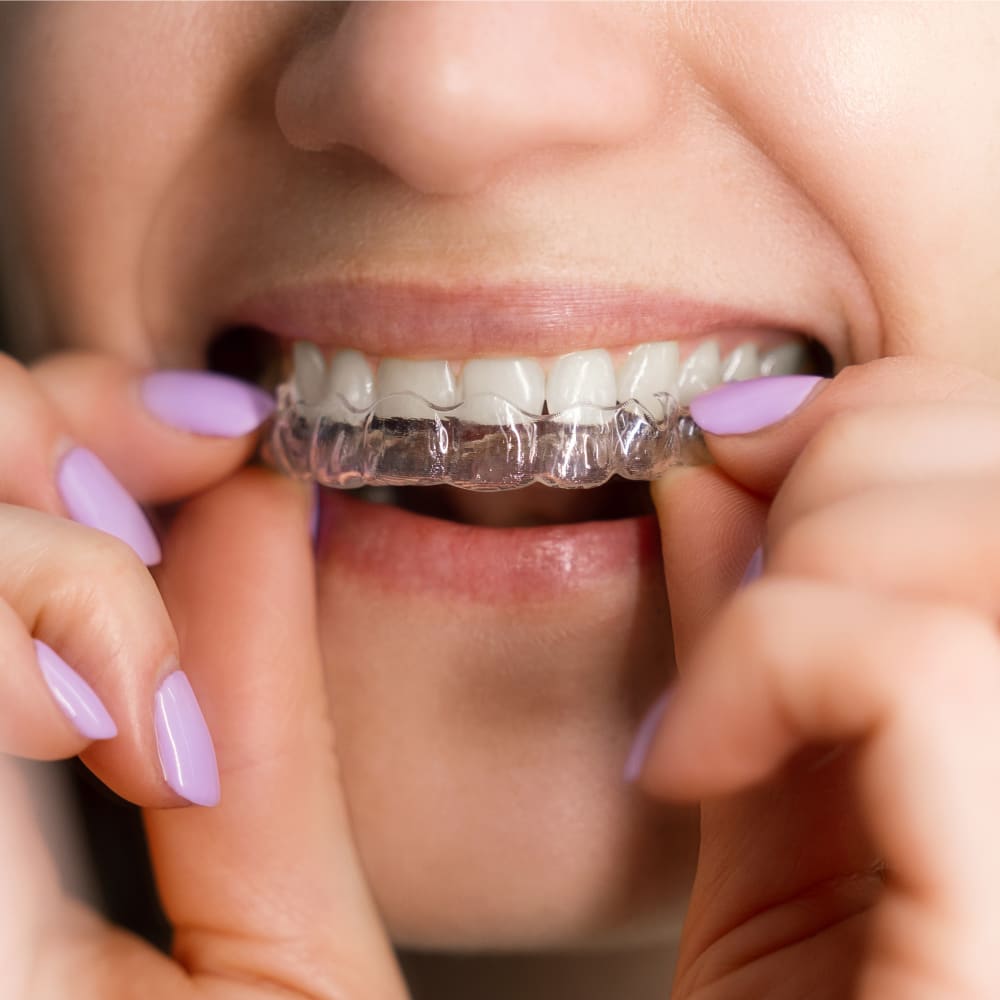 Close-up of a woman with pink nail polish inserting a clear aligner.