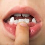 Missing Teeth – How Your Calgary Orthodontist Can Help
