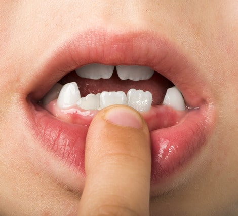 Missing Teeth – How Your Calgary Orthodontist Can Help