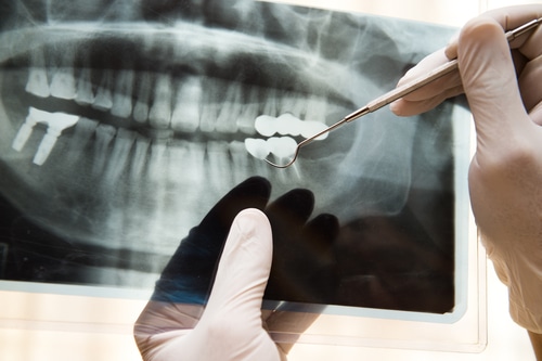 Calgary Orthodontist Explains Tooth Movement | Calgary