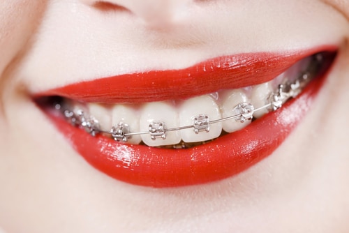 Can Orthodontic Treatment Really Help You Keep Your Teeth Longer?