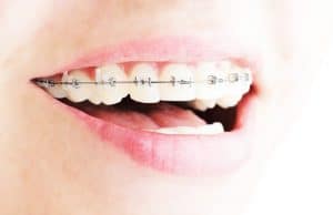 Are You Noticing White Spots Around Orthodontic Brackets?