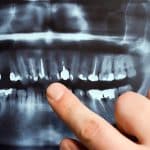 Image of a dental xray pointing at front teeth