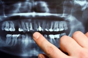 Image of a dental xray pointing at front teeth