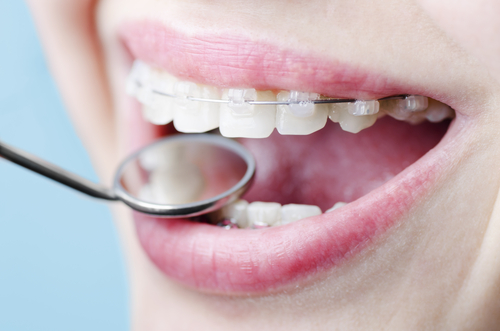 Orthodontic Treatment in Calgary - Customized For You
