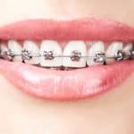 Why is Orthodontic Treatment so Important? | Calgary and Alberta Orthodontics