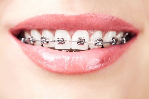 Why is Orthodontic Treatment so Important? | Calgary and Alberta Orthodontics