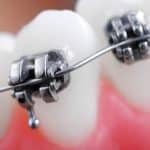 Just Got Braces – Here’s Some Tips on What to Eat