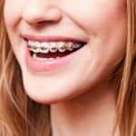 Why Your Smile Needs Orthodontic Braces - Cory Liss - Calgary Orthodontics