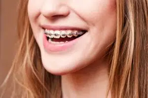 Why Your Smile Needs Orthodontic Braces