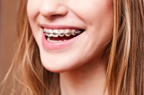 Why Your Smile Needs Orthodontic Braces - Cory Liss - Calgary Orthodontics