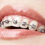 Adult Orthodontics – It’s Never Too Late For a Beautiful Smile - Cory Liss - Calgary Orthodontics