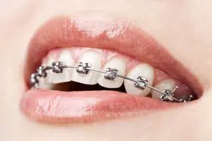 Adult Orthodontics – It’s Never Too Late For a Beautiful Smile - Cory Liss - Calgary Orthodontics