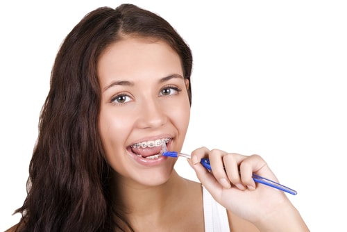 Preventing Decay While Wearing Orthodontic Braces | Calgary