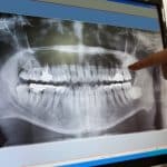 iTero™ Digital Scanner – Bringing Your Invisalign Treatment to Life - Cory Liss Ortho - Calgary Orthodontics