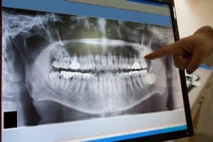iTero™ Digital Scanner – Bringing Your Invisalign Treatment to Life - Cory Liss Ortho - Calgary Orthodontics