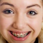 Are You Drooling Over Your Braces? | Calgary and Alberta