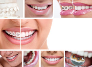 Invisalign Orthodontic Treatment - Cory Liss Orthodontics - NW Calgary Orthodontist
