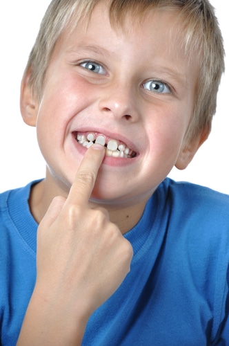 Why Do I Have a Gap Between my Front Teeth? - Cory Liss Orthodontics - NW Calgary Orthodontist