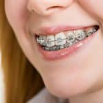 Why Doesn’t Everyone Wear the Same Braces? - Cory Liss Orthodontics - Orthodontics Calgary
