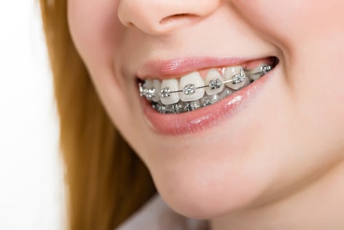 Why Doesn’t Everyone Wear the Same Braces? - Cory Liss Orthodontics - Orthodontics Calgary