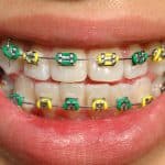 Wondering Why Your Braces are Still On? - Cory Liss Orthodontics - Orthodontics Calgary