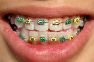 Wondering Why Your Braces are Still On? - Cory Liss Orthodontics - Orthodontics Calgary