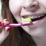 How To Clean Your Orthodontic Retainer? - Cory Liss Orthodontics - Dental Retainers Calgary
