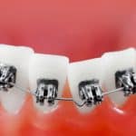 Why Are My Teeth Moving After Orthodontic Treatment? - Cory Liss Orthodontics - Teeth Straightening Options Calgary