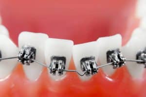 Why Are My Teeth Moving After Orthodontic Treatment? - Cory Liss Orthodontics - Teeth Straightening Options Calgary