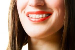 The Benefits of Accelerated Orthodontic Treatment - Cory Liss Orthodontics - Orthodontic Treatment Calgary