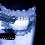 Invisalign After Braces? - Cory Liss Orthodontics - Orthodontists in Calgary