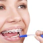 All About PROPEL Orthodontics - Cory Liss Orthodontics - Orthodontics in Calgary