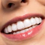 Benefits of Adult Invisalign Treatment - Cory Liss Orthodontics - Calgary Orthodontists