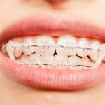 Importance of Elastic Wear During Treatment - Cory Liss Orthodontics - Orthodontists in Calgary