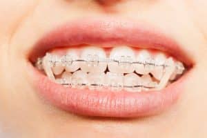 Importance of Elastic Wear During Treatment - Cory Liss Orthodontics - Orthodontists in Calgary