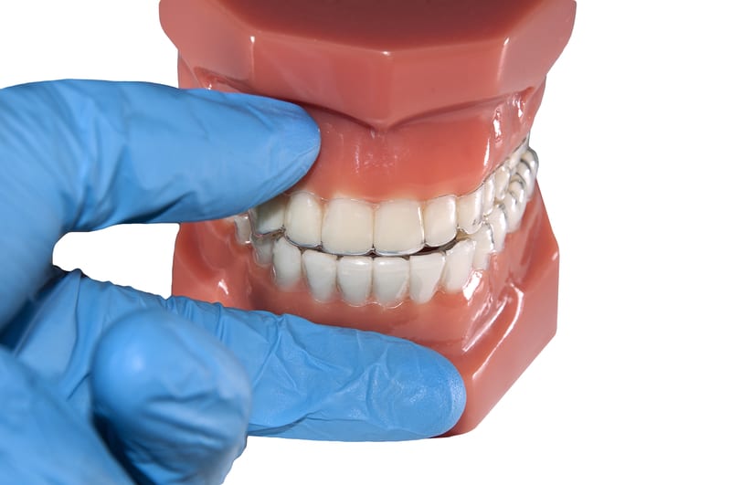 Daily Steps to Invisalign Success - Cory Liss Orthodontics - Orthodontics in Calgary