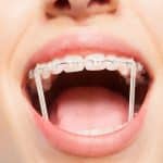 Why an Ideal Bite Is So Important - Cory Liss Orthodontics - Orthodontists in Calgary
