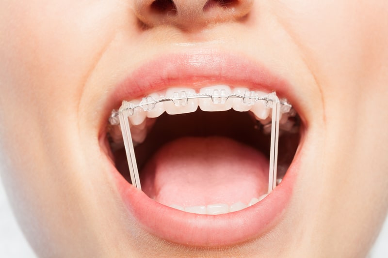 orthodontic elastic configurations
