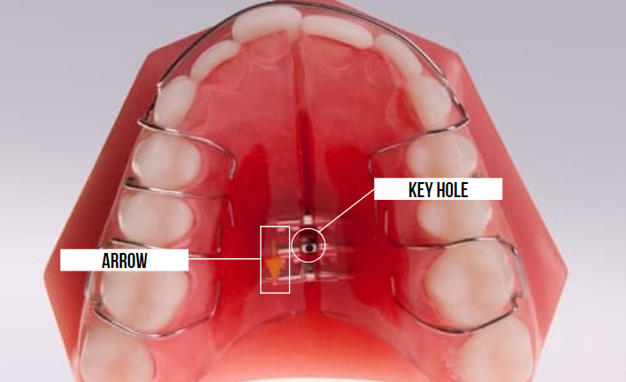 Palatal Expander-NW Washington DC Orthodontist