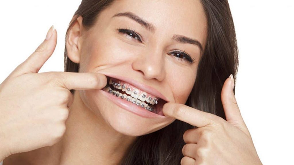 Types of Orthodontic Elastics And Why You Need to Wear Them